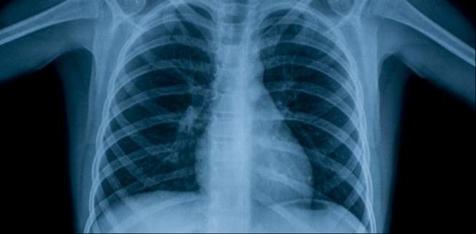 La pandemia provoca un descenso en diagnóstico y tratamiento de tuberculosis