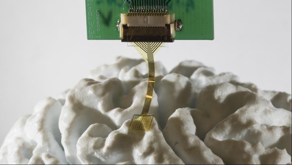 ¿Se puede tratar la epilepsia con implantes cerebrales?